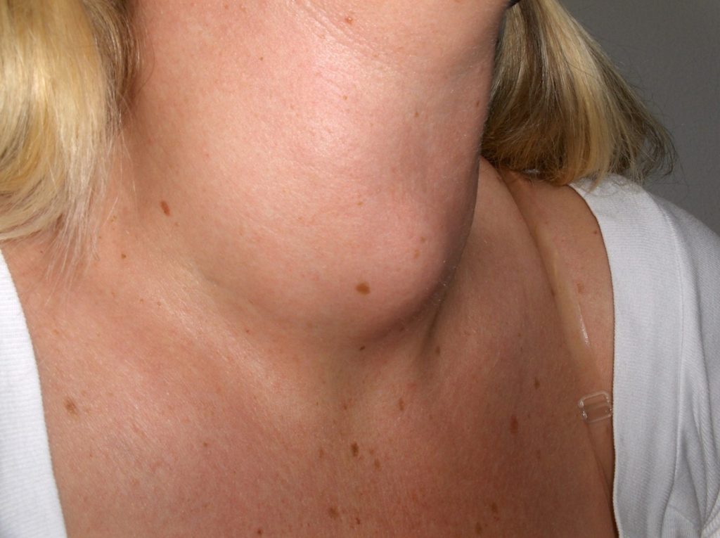 THYROID LUMPS OR NODULES TREATMENT SINGAPORE