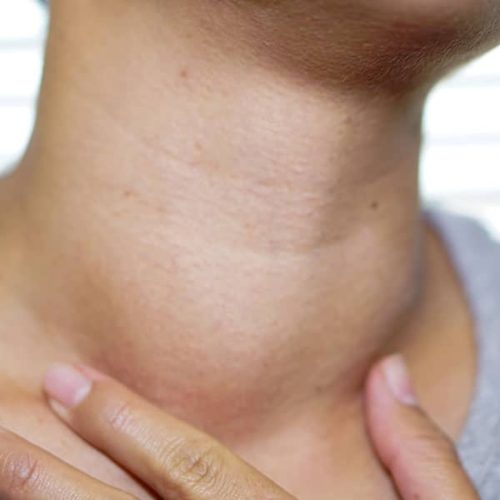 Thyroid Gland Tumours