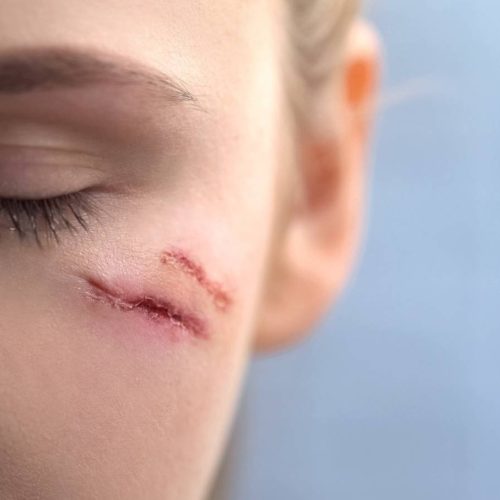 Facial Laceration Repair