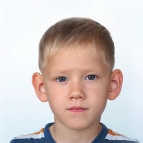 Prominent Ear Surgery