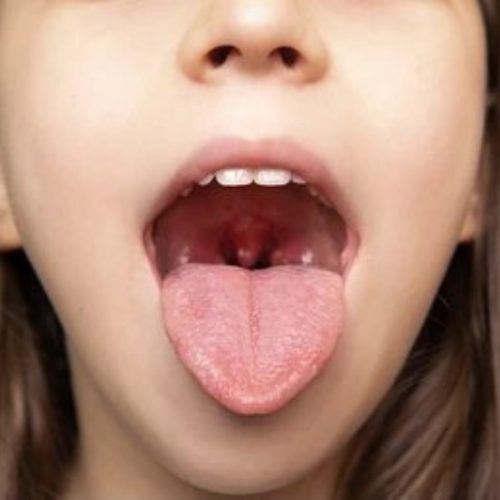 Tonsils & Adenoid Issues